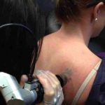 Newcastle Tattoo Removal