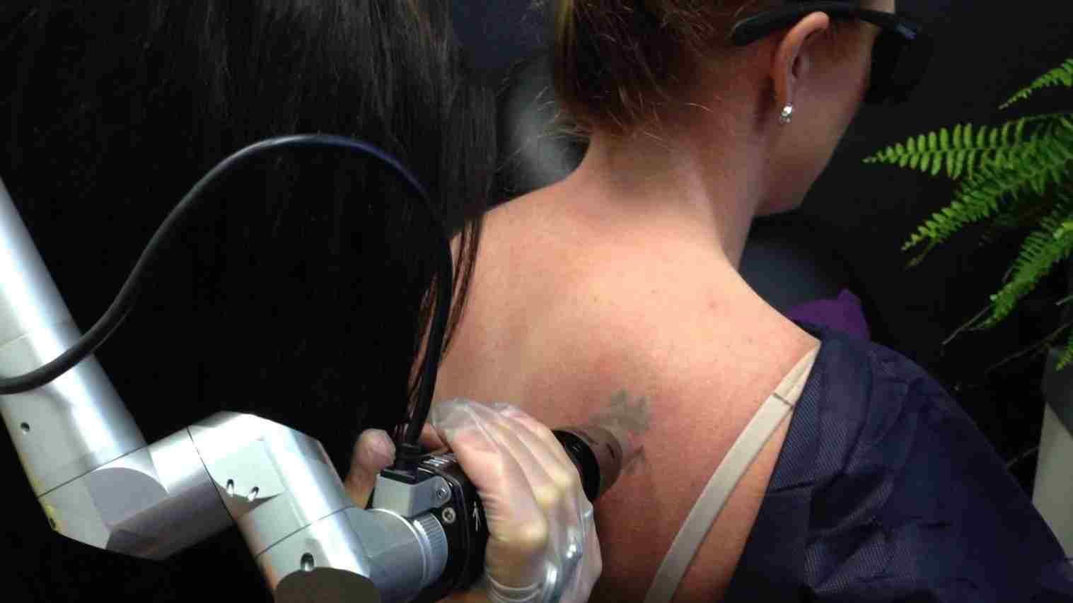 Newcastle Tattoo Removal